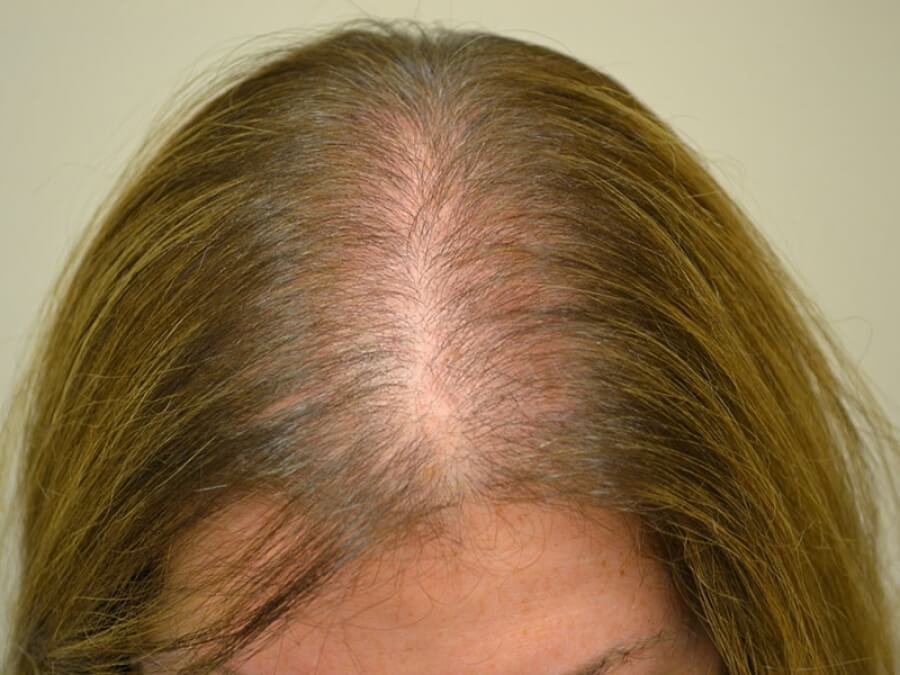 the main image - Iron deficiency hair loss women